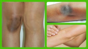 आपके भी घुटने और कोहनी हैं डार्क, तो अपनाएं उपाय beauty tps in hindi